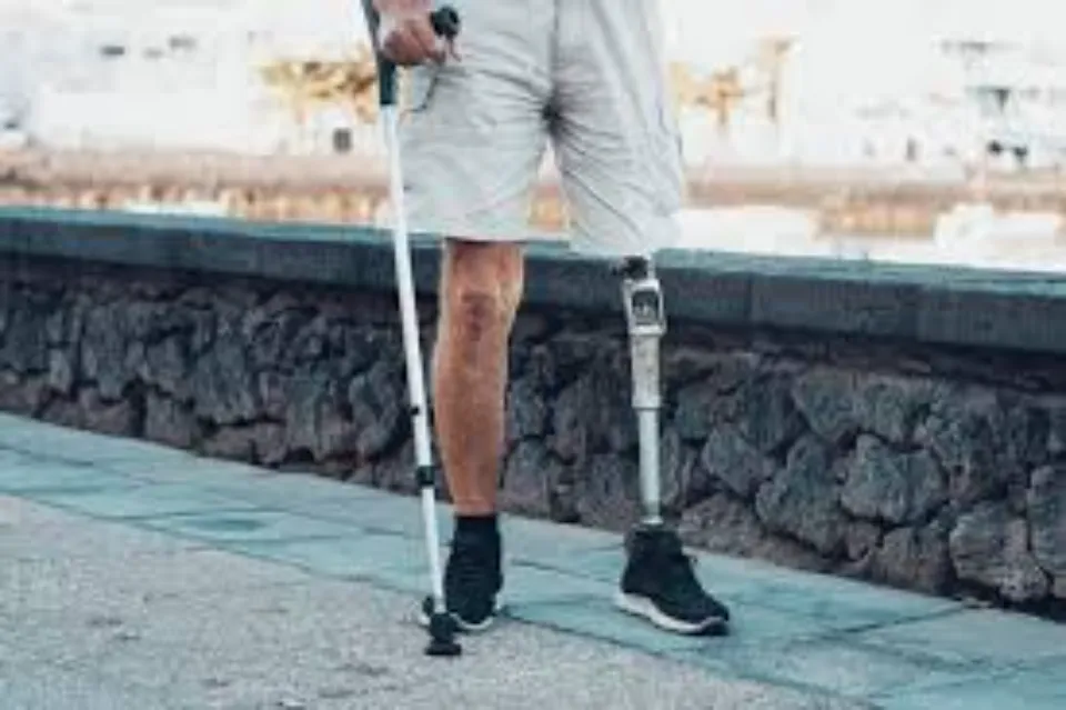 amputación por negligencia médica