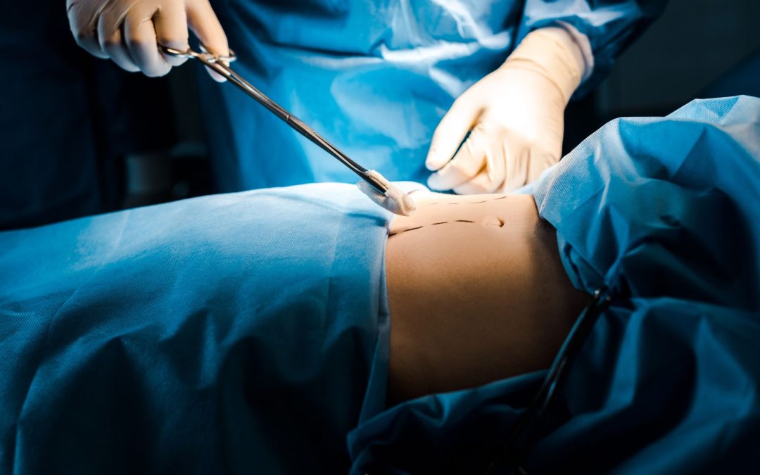 Qué Hacer si Sufres de Negligencia Médica en Liposucción
